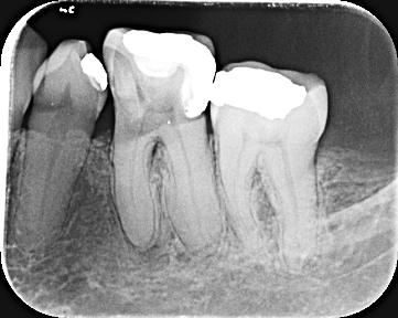 periapical digital